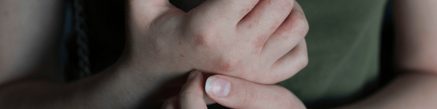 topical steroid withdrawal