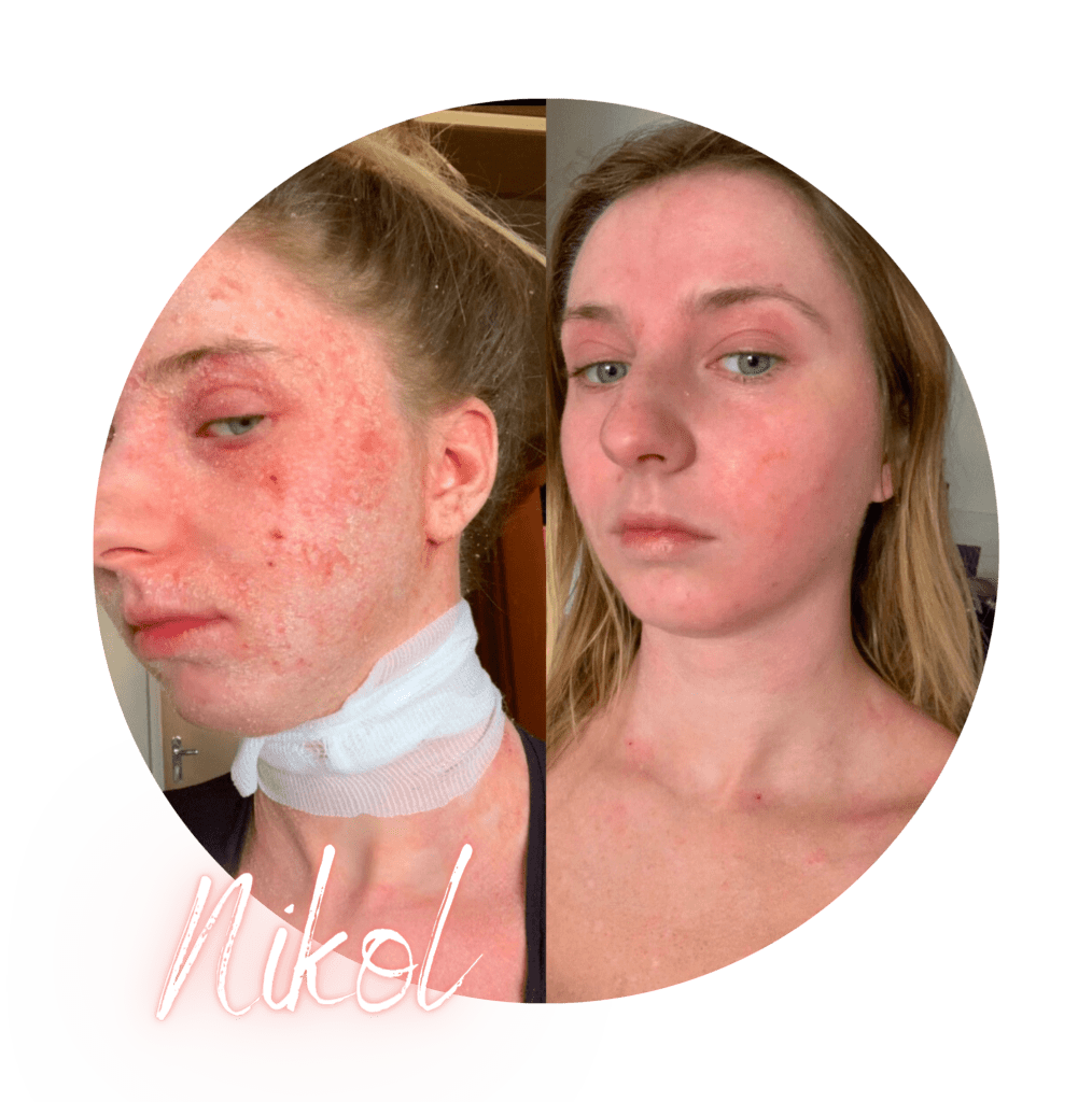 Co je to TSW Topical Steroid Withdrawal?