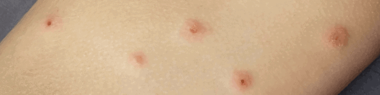 impetigo ekzém