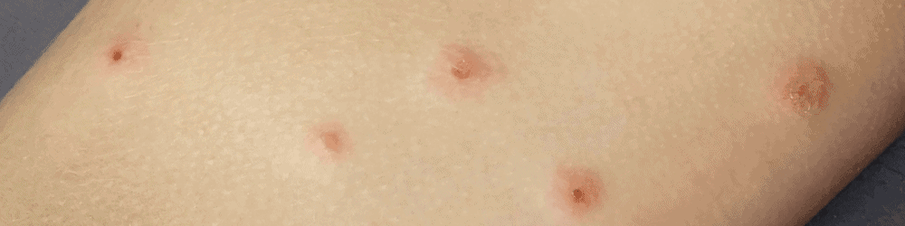 impetigo ekzém